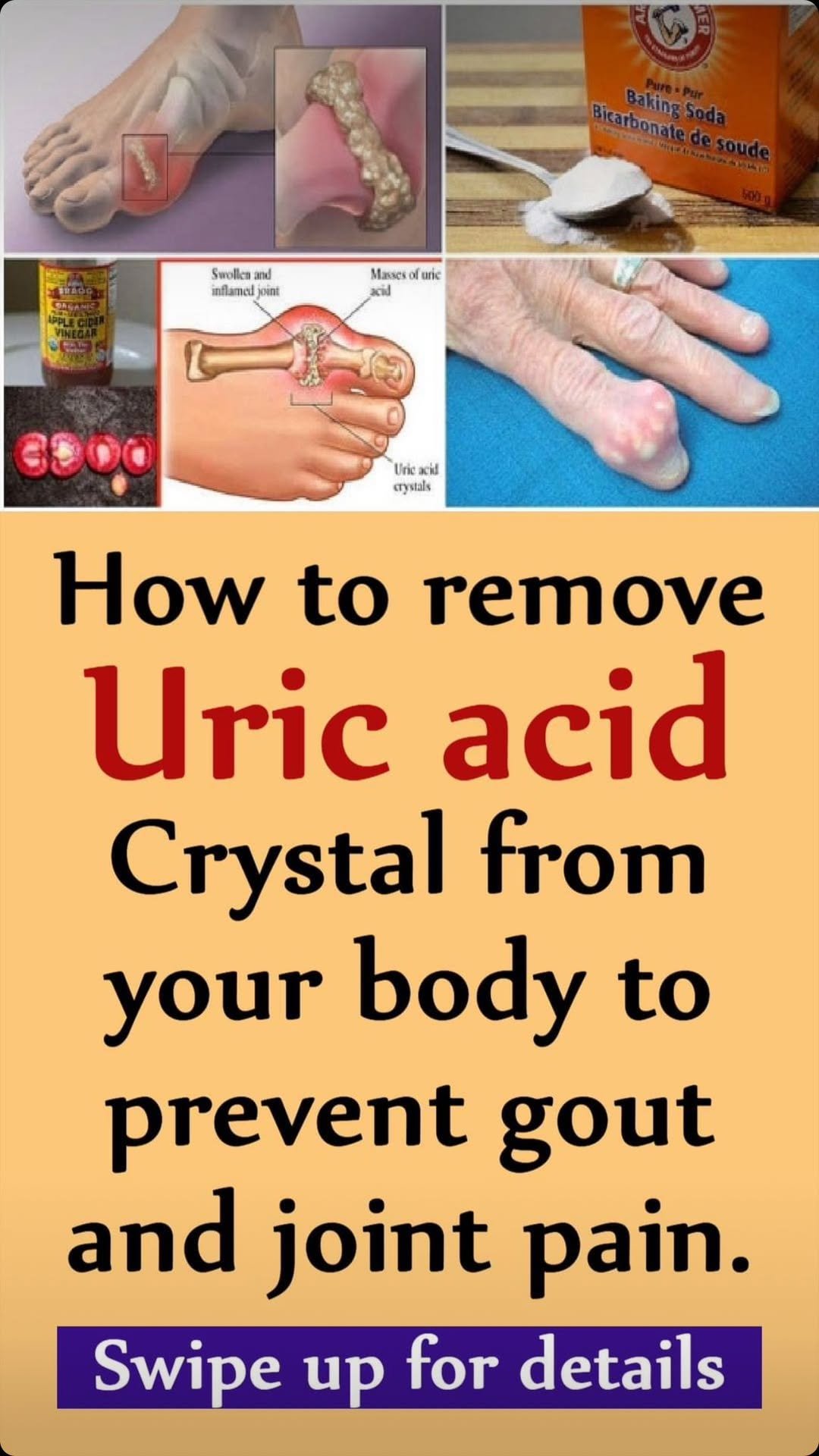 How To Quickly Remove Uric Acid Crystallization From Your Body To Prevent Gout And Joint Pain