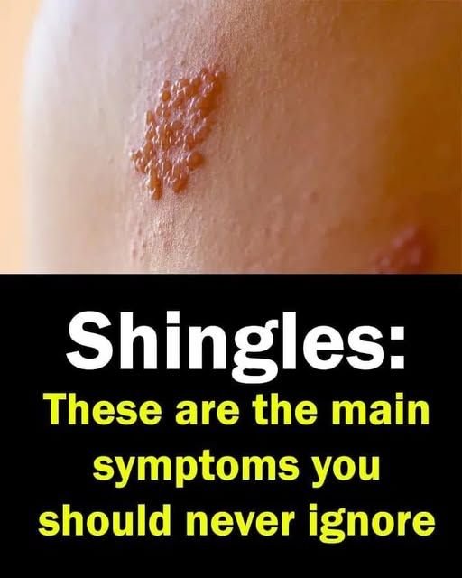 Shingles: These are the main symptoms you should never ignore